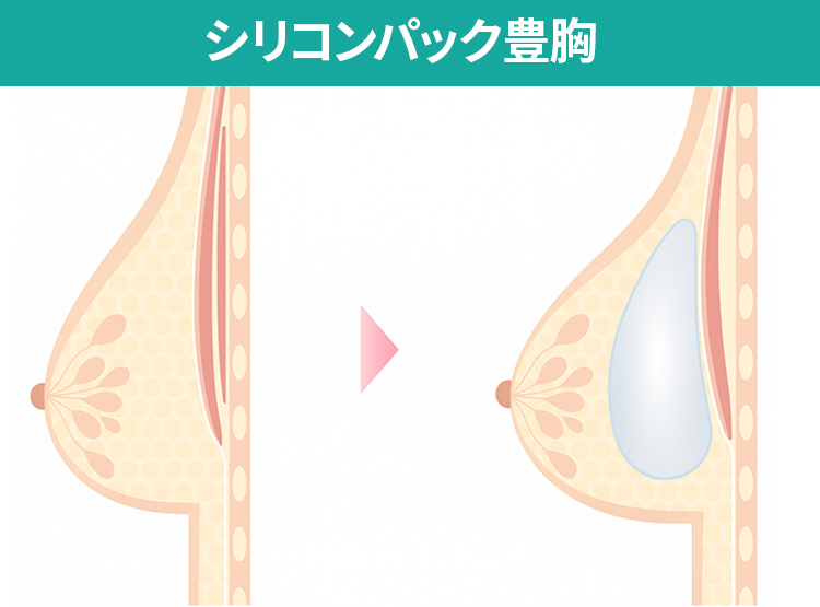 シリコンバッグ豊胸の画像