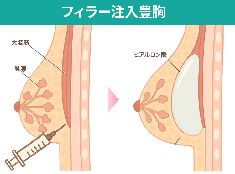 フィラー(ヒアルロン酸・アクアフィリング)注入豊胸の画像