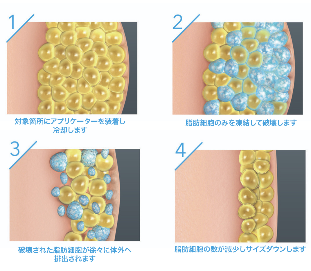 脂肪冷却(クールスカルプティング)の画像