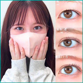 二重整形の症例写真
