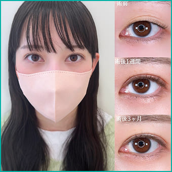 二重整形の症例写真