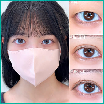 二重整形の症例写真