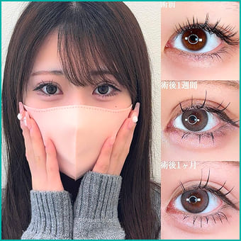 二重整形の症例写真
