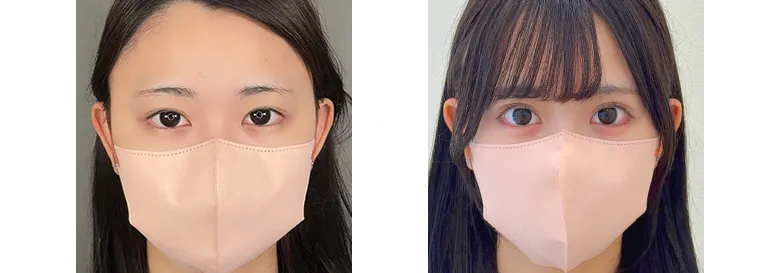 二重症例写真
